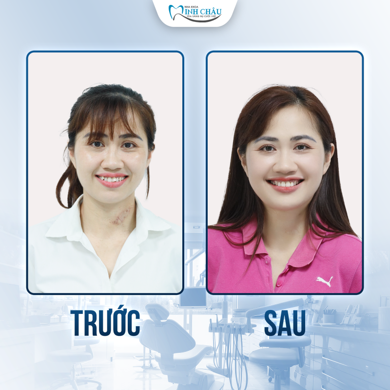 niềng trong suốt