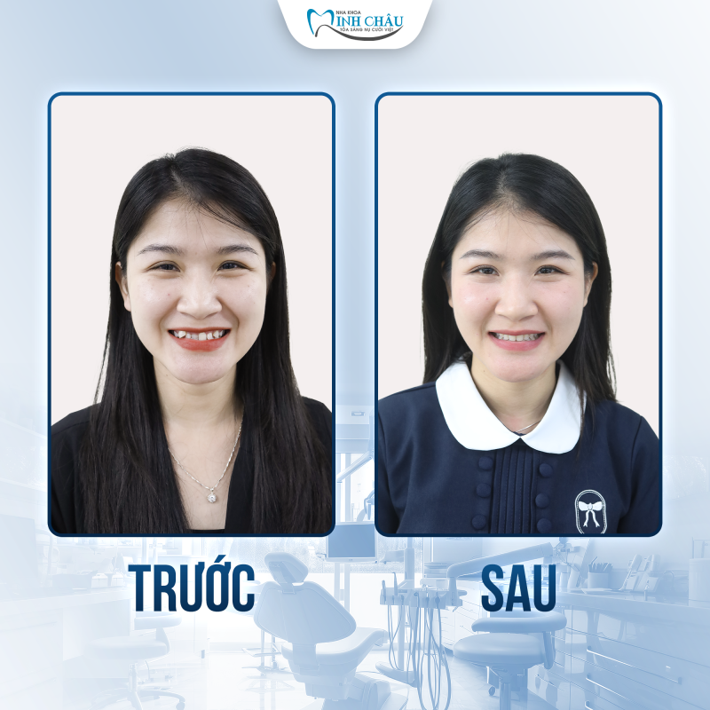 niềng răng mắc cài