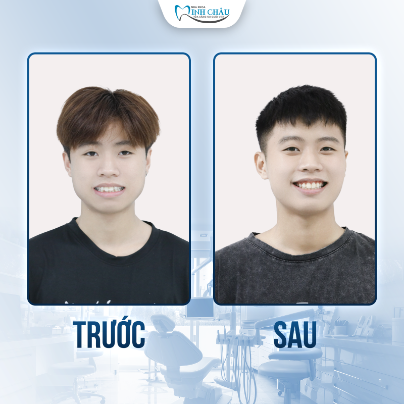 niềng răng mắc cài