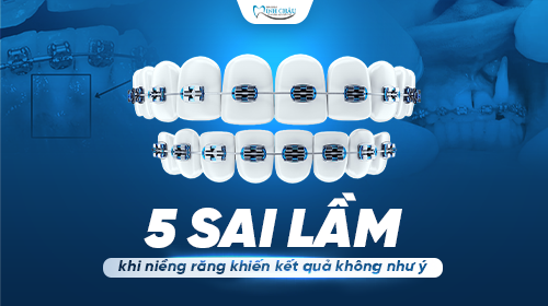 Top 5 sai lầm khi niềng răng khiến kết quả không như ý